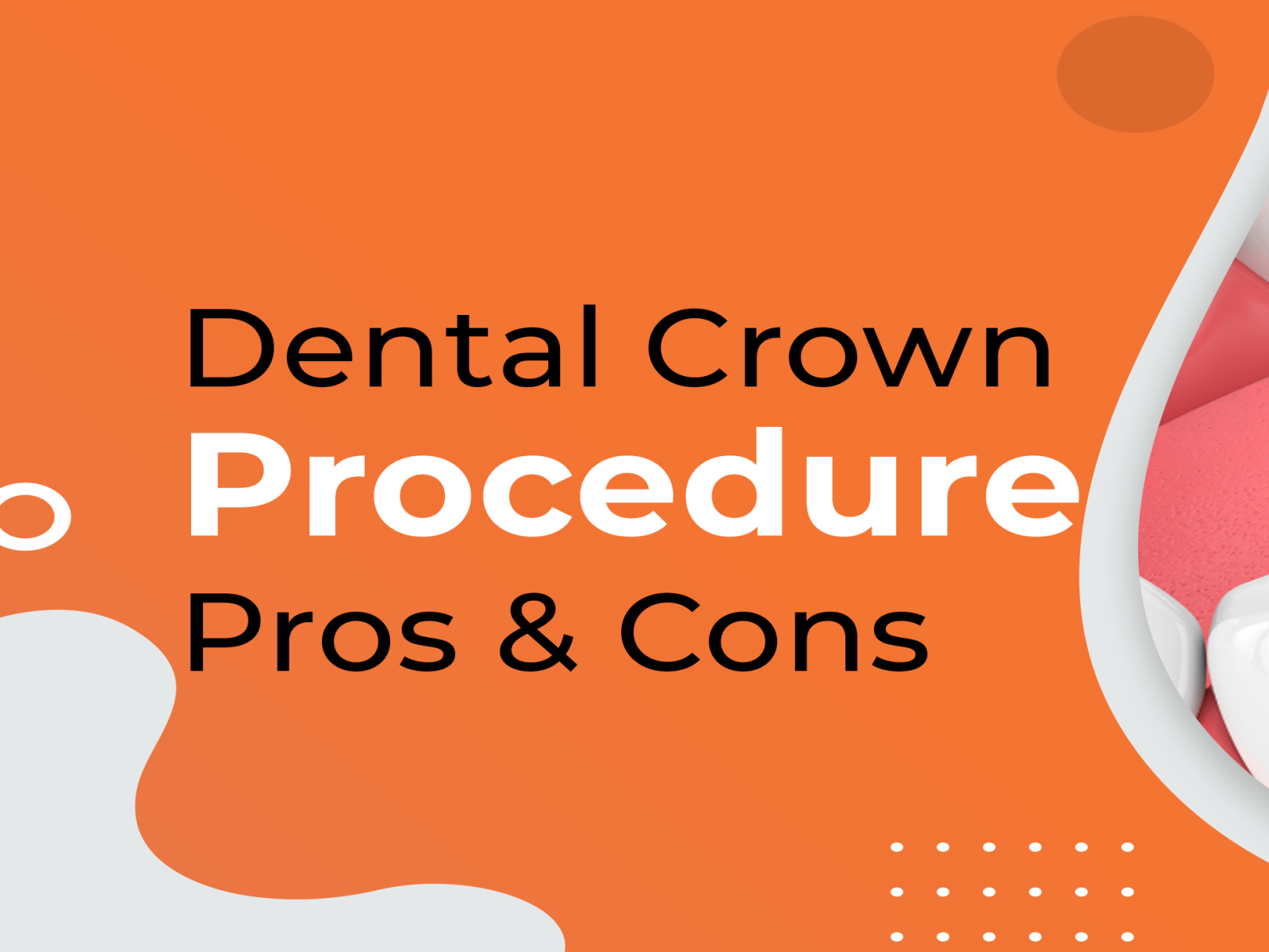 things-you-need-to-know-about-dental-crown-procedure-by-bharti-bhati-on