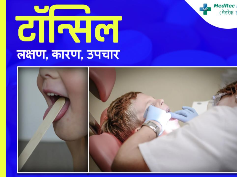 tonsil-stones-causes-symptoms-and-treatment-in-hindi-by-medrec