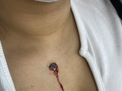 Gunshot wound using silicon gun