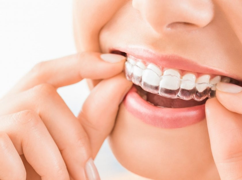 How Does Clear Aligner Therapy Actually Move My Teeth? by Tomasz Mazgaj