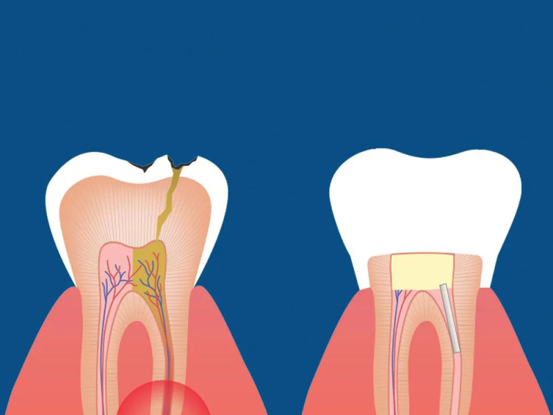 Guide to the Root Canal Procedure by Tomasz Mazgaj on Dribbble