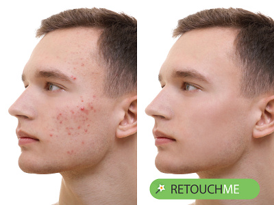 Nose Acne Treatment: How to Get Rid of Pimples on Nose?