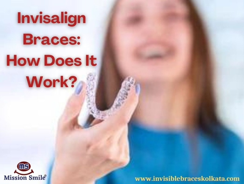 Invisalign Braces How Does It Work? by Invisible Braces Kolkata on