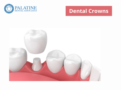 Dental Crowns in Palatine by Palatine Dental Associates on Dribbble