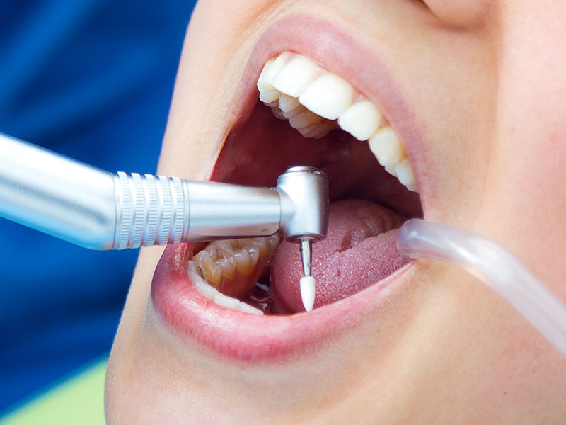 Pain Free Root Canal Services by Roseland Dental by Dr Vageesh