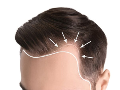 Hair Restoration by PRP treatments