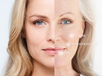 Juvederm in NZ anti wrinkle treatments dermal fillers juvederm skin tightening skin tightening treatments