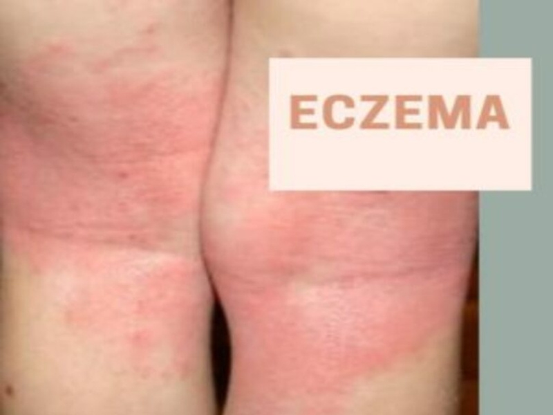 Best Dermatologists For Eczema Treatment In Singapore by Health Springs