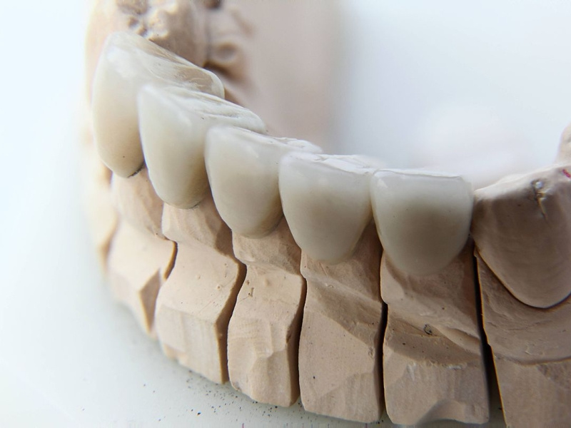 Affordable Dental Crowns Near Me by GeraldHatley on Dribbble