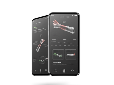 Smart splint app design interaction ui ux