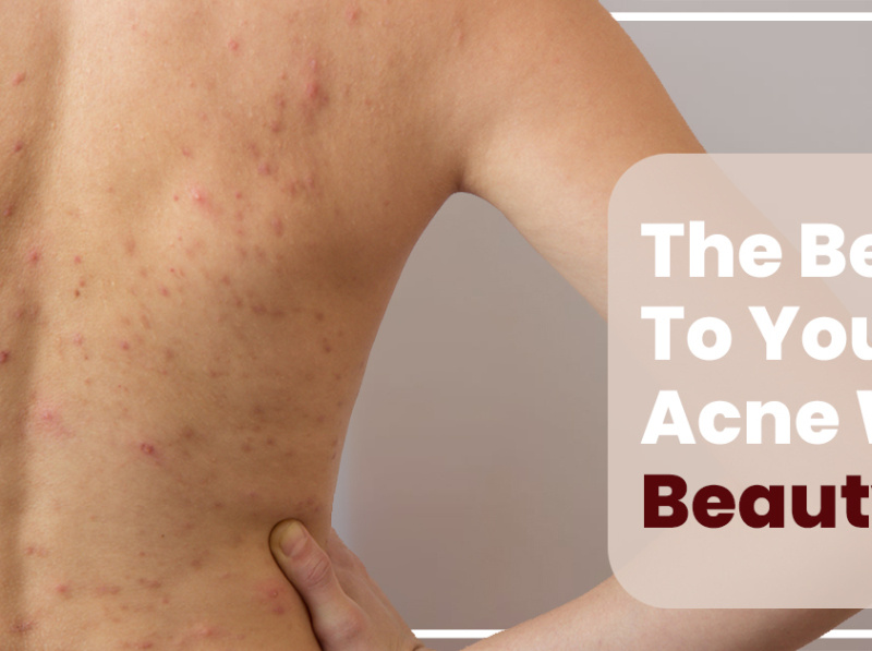 Best back acne treatment