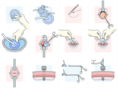 Abdominal hernia surgery patch - medical illustrations design flat healing hospital instruction lineart manual medic stroke vector