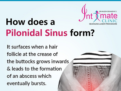 Pilonidal Sinus Treatment in Indore - Dr Nilesh Dehariya by Piles ...