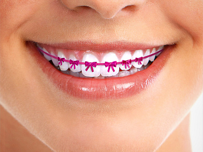 Braces braces smile teeth tooth