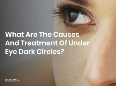 What are the causes and treatment of under eye dark circles?