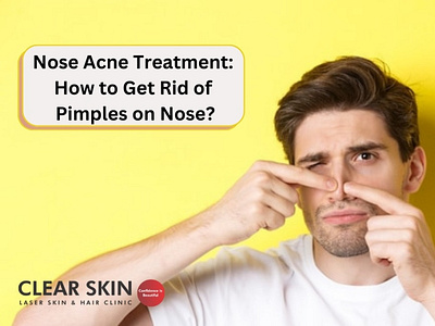 Nose Acne Treatment: How to Get Rid of Pimples on Nose? acne treatment nose acne