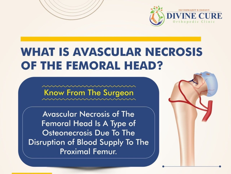 What is avascular necrosis of the femoral head? Dr. Vishwajeet by Dr