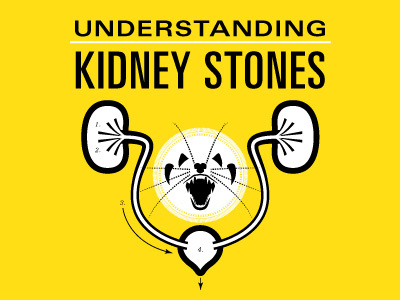 Understanding Kidney Stones design furious graphic illustration kidney stone medical pain poster weasel