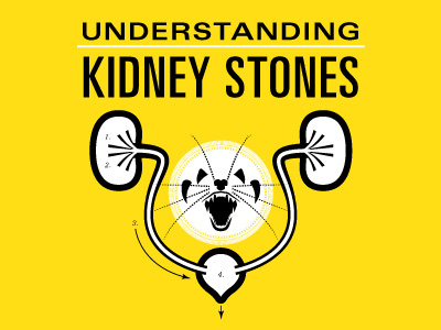 Understanding Kidney Stones