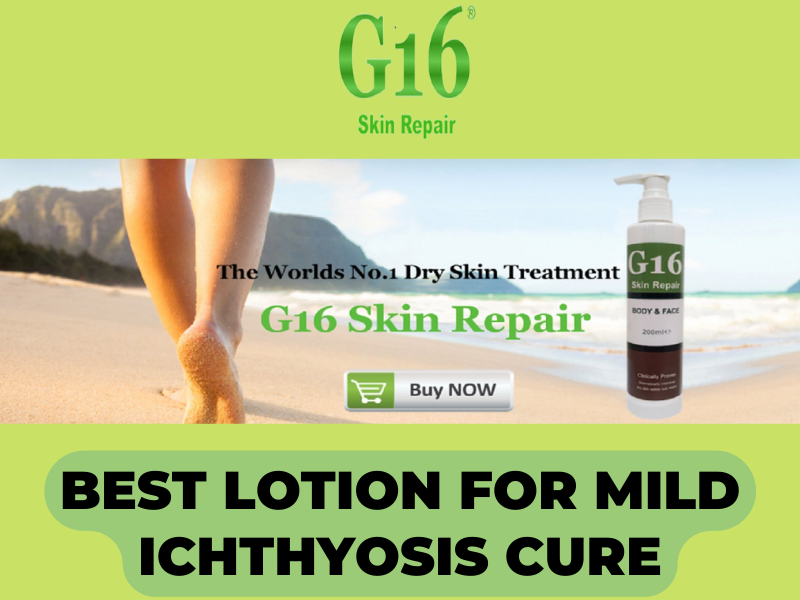 Best Lotion for Mild Ichthyosis Cure by G16 Lotion on Dribbble