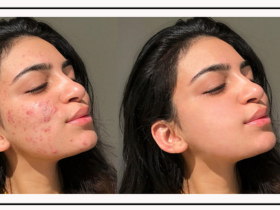 Female acne remove photo editing