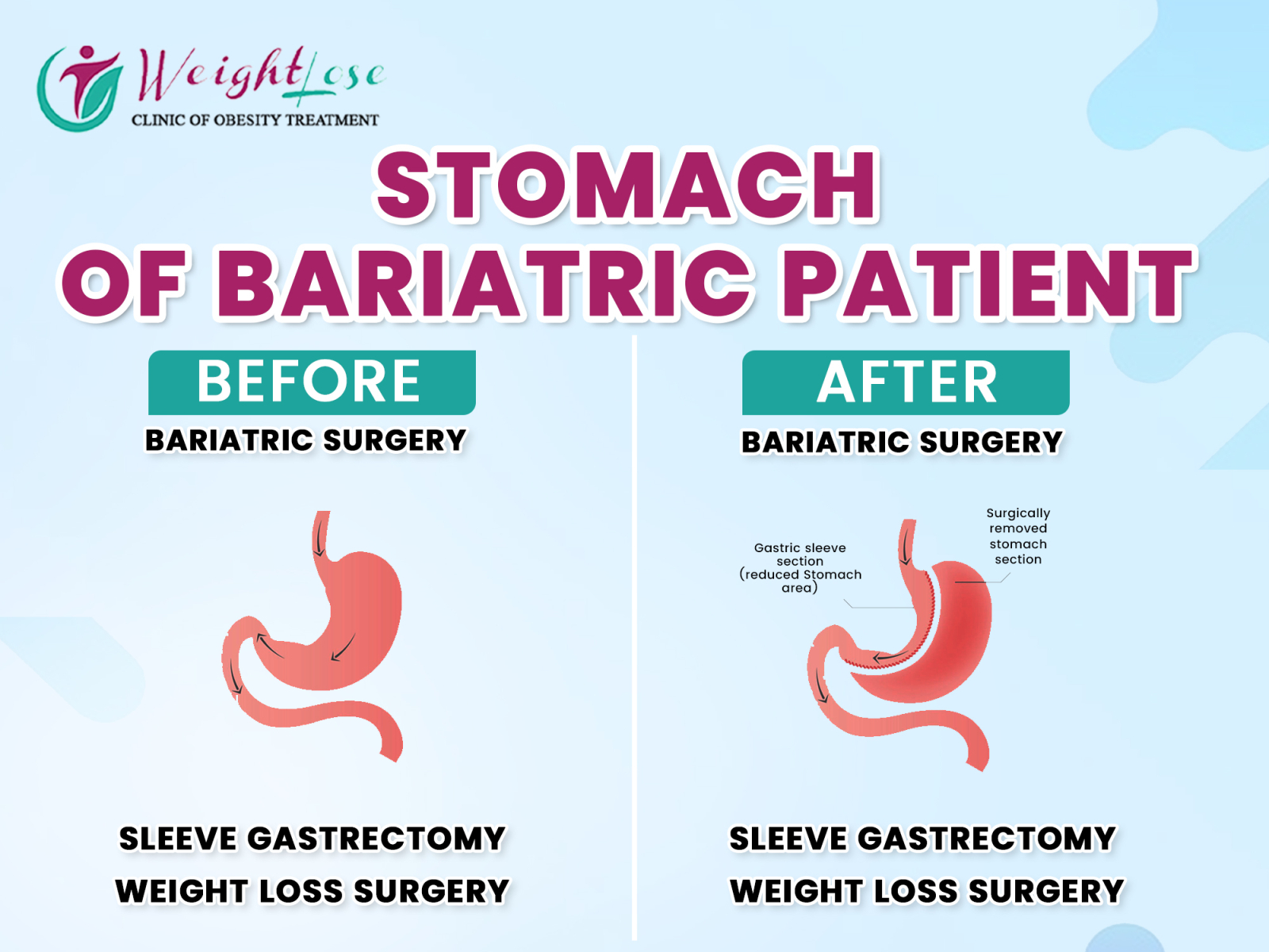 best-gastric-bypass-surgery-in-delhi-ncr-by-ayushi-sharma-on-dribbble