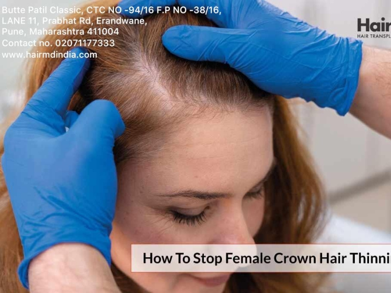 how-to-stop-female-crown-hair-thinning-by-swamini-on-dribbble