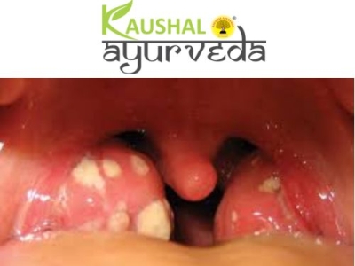 Tonsils Ayurvedic Medicine & Tonsil Treatment In Ayurveda by kaushal ...