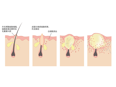 illustration about causes of acne
