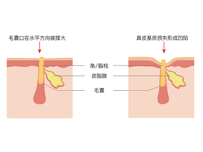 illustration about causes of pore