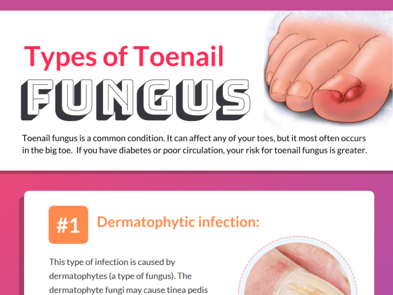 Causes and Symptoms of Fungal Nail Infection