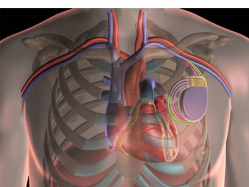 Best Doctor for ICD Implantation in Delhi NCR. by Dr Vivek Kumar on
