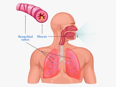 Buoy Health Bronchitis Article