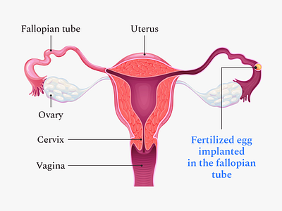 Buoy Health Ectopic Pregnancy Article Illustration article editorial healthcare illustration organs pregnancy