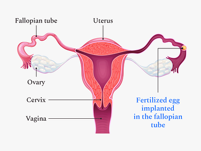 Buoy Health Ectopic Pregnancy Article Illustration