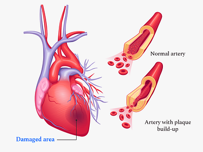 Buoy Heart Attack Article Illustration artery article attack disease health illustration organs