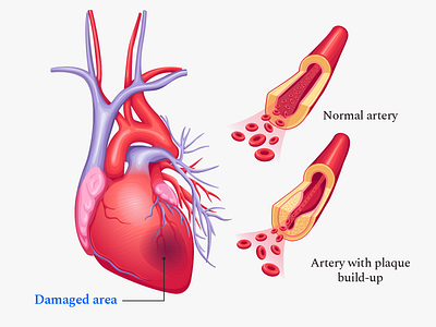 Buoy Heart Attack Article Illustration