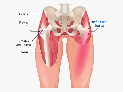 Buoy Healthy Hip Bursitis Article Illustrations body health app healthcare hip human illustration muscules