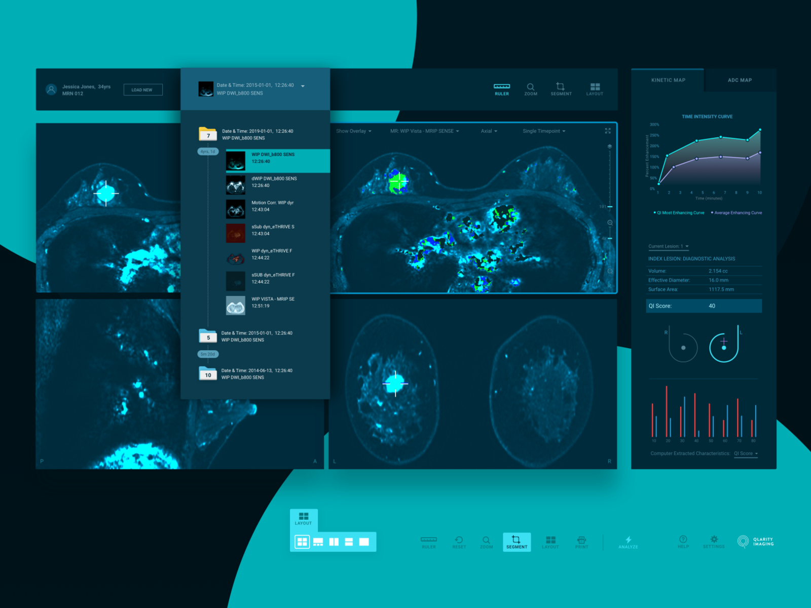 qview breast cancer ai