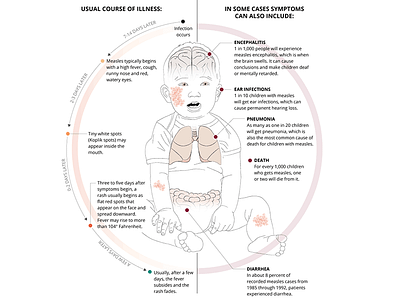 How Measles Affects Your Body infographic measles