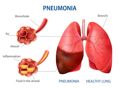 Pneumonia human set bronchi illustration lung pneumonia realistic symptoms vector