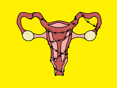 Endometriosis endo endometriosis ovaries uterus