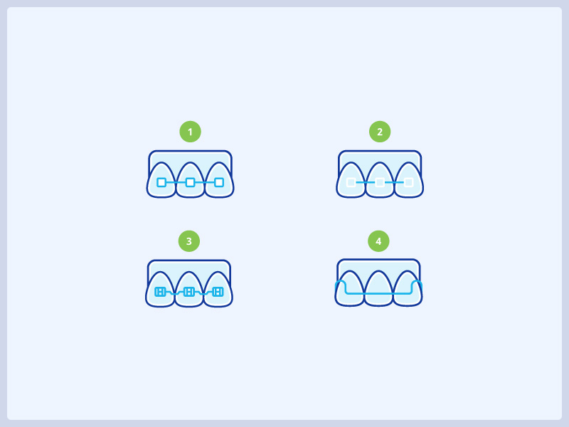 Types of braces icons braces dental dental icons icon icons medical illustration orthodontist