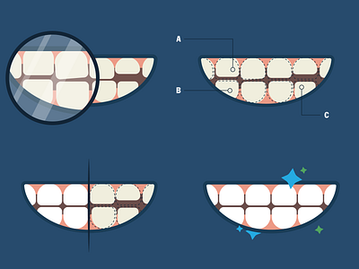 Prosthodontic Process Illustration illustration mouth process teeth vector web design wierstewart