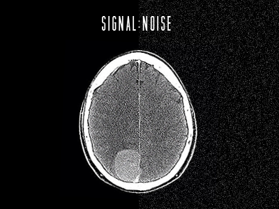 signal:noise brain grayscale noise tumor