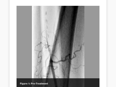 Ev3 Angiogram