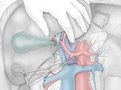 Multivisceral Transplant anatomy illustration multivisceral surgery transplant