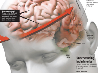 Brain injuries design illustration infographic