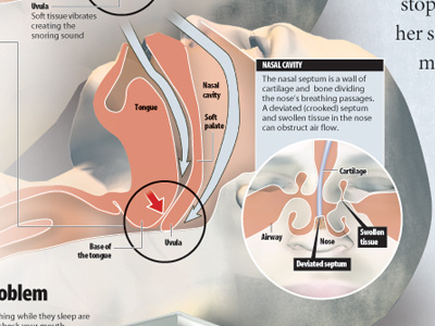 Sleep apnea infographic design illustration infographic