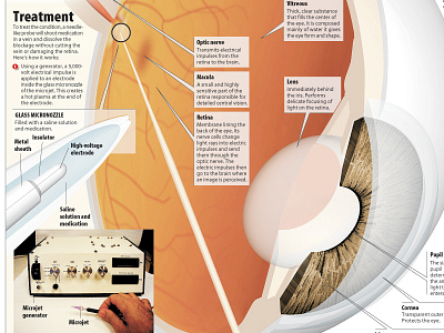 Eye opening development eye infographic treatment